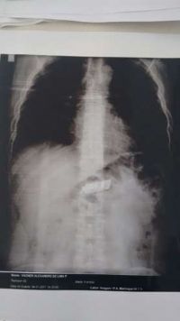 Condenado na Penitenci�ria de Mairinque � operado para tirar celular do est�mago